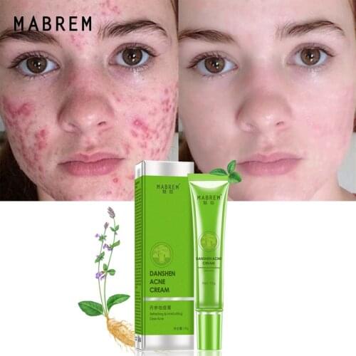 Acne Removal Cream Effective Acne Treatment Fade Acne Spots Oil Control Shrink Pores Anti-Inflammatory Anti-Acne Moisturizer Gel