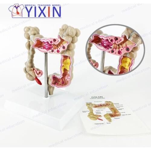 Human Colorectal Lesion Model Pathological Anatomy Colon of Digestive System Diseases Large Intestine Medical Teaching Tool