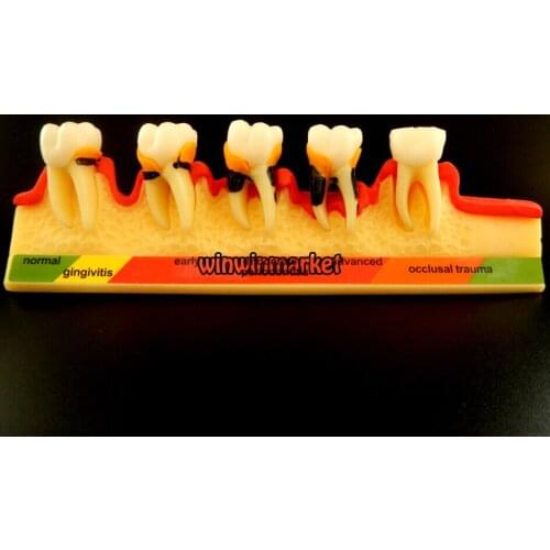 5 Stage Dentist Odontologia Periodontal Disease Dental Teeth Model Tooth ZYR-4010
