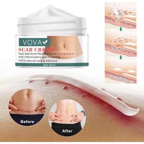 30ml Scar Removal Cream Acne Scars Stretch Marks Surgical Scar Burn For Body Pigmentation Corrector Acne Spots Repair Skin Care