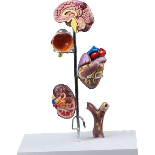 Human Hypertensive Model Cerebrovascular Medicine General Anatomical Surgery Teaching Aid