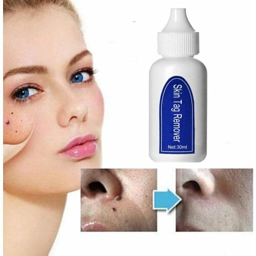 30ml Skin Tag Remover Liquid Wart Removal Freckle Wart Dark Spot Remover Wart Body Tag Freckle Skin Care Liquid