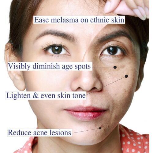 Glycolic Acid 30% Renewal Peel Exfoliator Pure AHA Cosmetic Strength Free Shipping