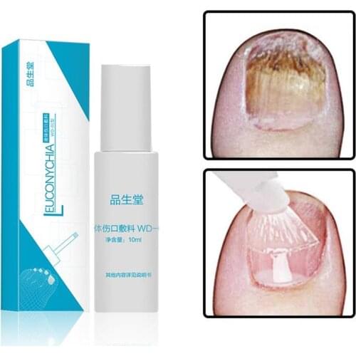 10 Ml Fast Fungal Nail Treatments Remove Onychomycosis Paronychia Repair Care Essences Nail Treatments