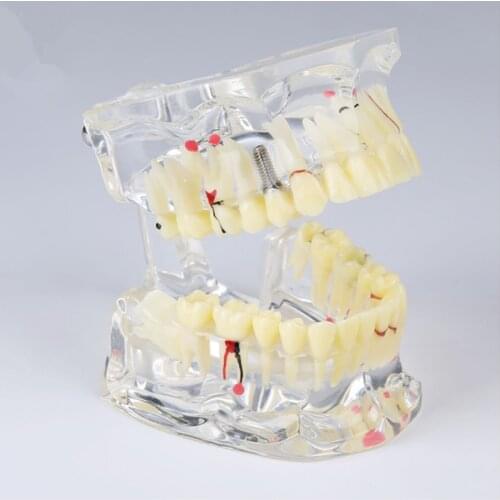Dental Study Tooth Transparent Adult Pathological Teeth Model/Dental Implant Disease Teeth Model M4001/ Implant Disease Model