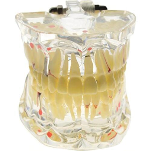Promotion Dental Study Tooth Transparent Adult Pathological Teeth Model Dental Lab Equipment Dentist Teaching