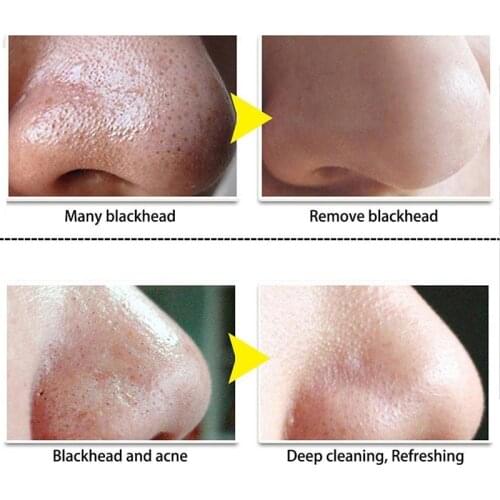 Tea Tree Oil Essence Cleansing NosePore Strip Remove Oil Black Head Pimple Patch Thoroughly clean the face with warm water