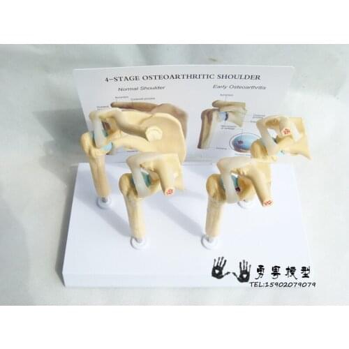 Human shoulder joint model Pathological shoulder joint model