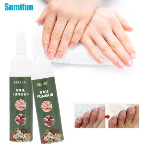1Pcs 20ml Nail Anti Fungal Cream For Treat Paronychia Onychomycosis Foot Toe Finger Nail Antibacterial Ointment Care Plaster