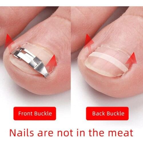 1pair Ingrown Nail Correction Nail Fixer Embed Toenail Foot Correction Care Recover Pedicure Tool Pedicure Tool Lifter Tool D0D7