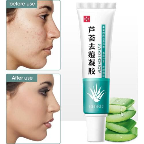 Aloe gel acne cream Anti-acne treatment Fade dark spots Oil control Whitening Moisturizing repair Skin care products