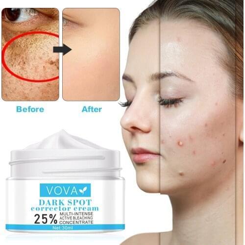 VOVA Effective Whitening Freckle Cream Remove Melasma Acne Spot Pigment Melanin Dark Spots Pigmentation Moisturizing Gel