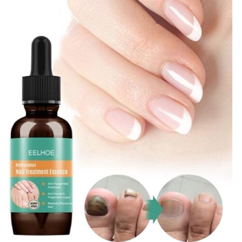 30ml Hand Foot Nail Fungus Removal Gel Anti Infection Paronychia Onychomycosis Fungal Nail Repair Essence Treatment