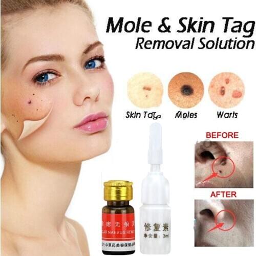 Mole & Skin Tag Removal Solution Painless Mole Skin Dark Spot Removal Face Wart Tag Freckle Removal Cream Oil Plaster
