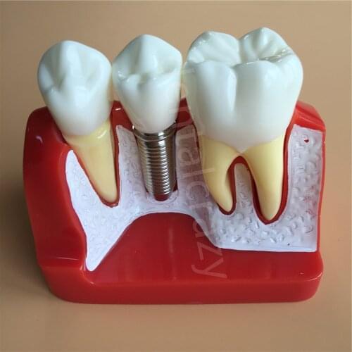 Dental Teach Implant Analysis Crown Bridge Removable Model Dental Demonstration Teeth Model
