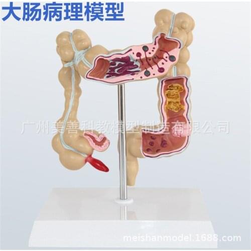 1/2 Life Size Human Rectal Pathology Colon Model Large Intestine Model Anorectal Anatomical Model Tools