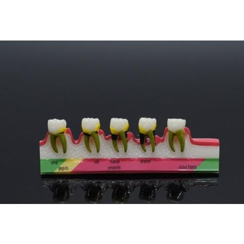 Dentistry Periodontal Disease Assort Tooth Typodont Study Teaching Model For Dental Clinic