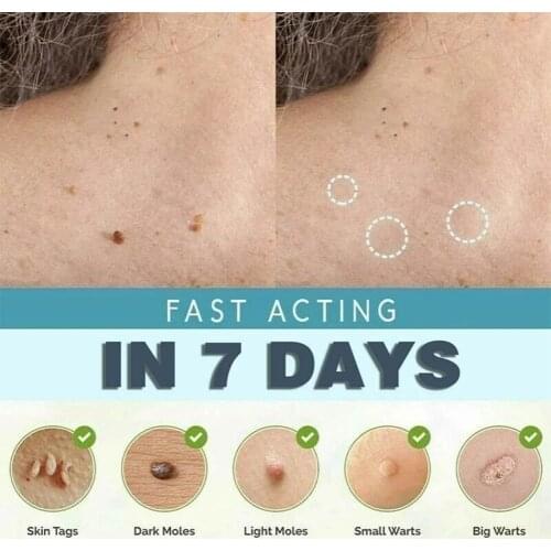 All Copper Pointed Mouth Wart Removal Clip Pointed Mouth Toothless Flat Mouth Skin Remover Label Small Clip Used To Remove Warts