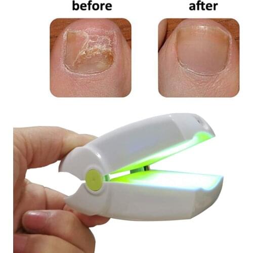 905nm 470nm LLLT Cold Laser Therapy Device Soft Laser Therapy Device For Finger Nails Fungus Treatment Toe Nails Fungus Removal
