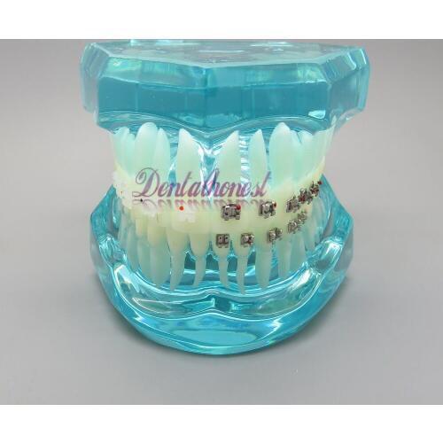 Transparent Dental Orthodontic Mallocclusion Model with Ceramic and Metal Brackets for Patient Communication