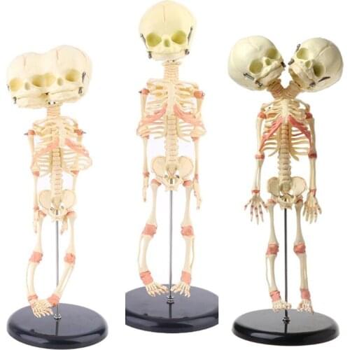Human Baby Deformed Head Skull Research Model Skeleton Anatomical Brain Anatomy Teaching Study Display