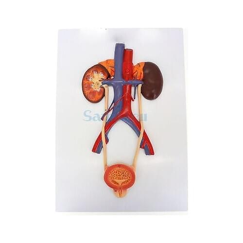 Anatomy Teaching Model Medical Bladder Liver Kidney Wall Plaque Urinary System