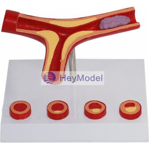 HeyModel Human vascular atherosclerosis model