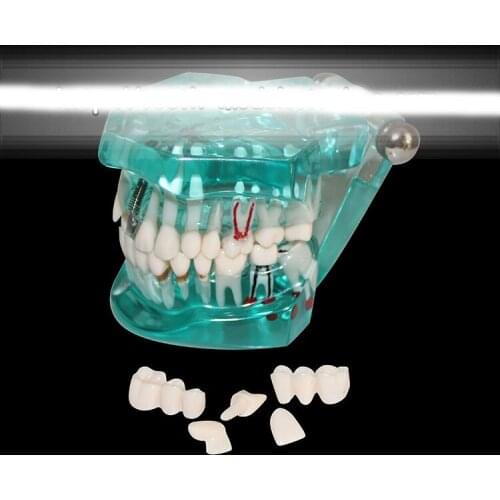 Dental pathology model Dental caries dental plaque planting tooth model Dental Implant teaching Model