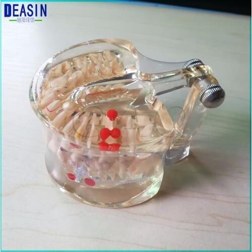 Good quality Teeth Half side can be removeble model Pathological Model Teaching& Restoration Bridge Tooth Implant Dismantled