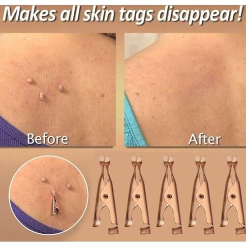 Skin Tags Remover Clip 1/2pcs Mole Remover Clip Blackhead Skin Blemish Removers Coppers Tags Out Beauty Makeup Tools
