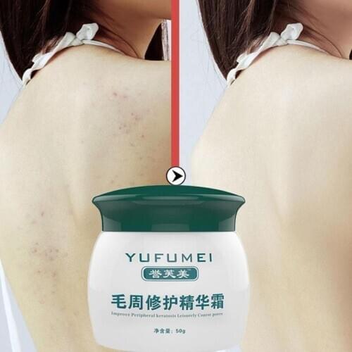 New Hot 50g Curing Keratosis Pilaris/ Kp/ Chicken Skin Body Lotion Skin Repair Cream Skin Care Essence Moisturizing Nourishing
