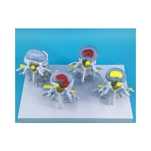 Medical body Lumbar disc herniation Demo model spine model free shipping