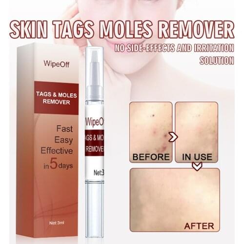 Skin Tags Moles Warts Corn Remover Liquid Pen Restore Skin Beauty Against Moles Removing Genital Wart Treatment Serum