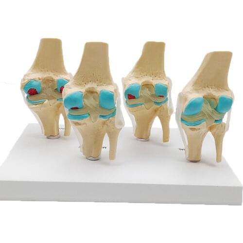 Four-stage Human Pathological Knee Joint Anatomy Model Medical Science Teaching Resources Dropshipping
