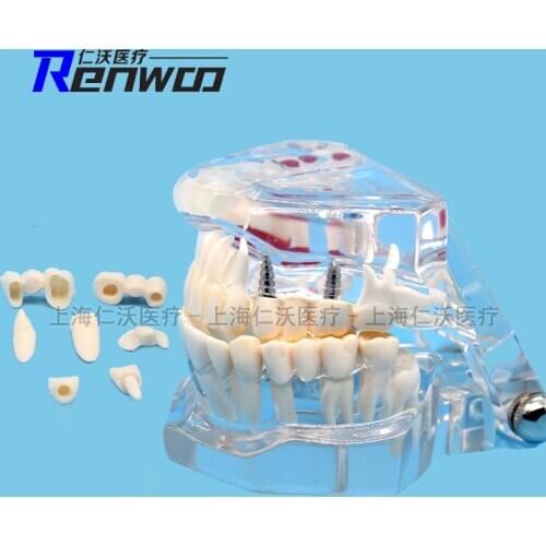 Dental tooth model teeth Teaching demonstration model Transparent pathology Planting nerve repair skeleton free shipping