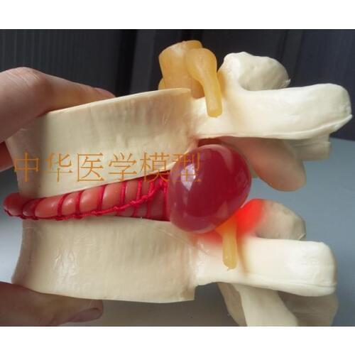 Lumbar spine enlargement lumbar disc herniation model human spine Vertebral pathology demonstration model