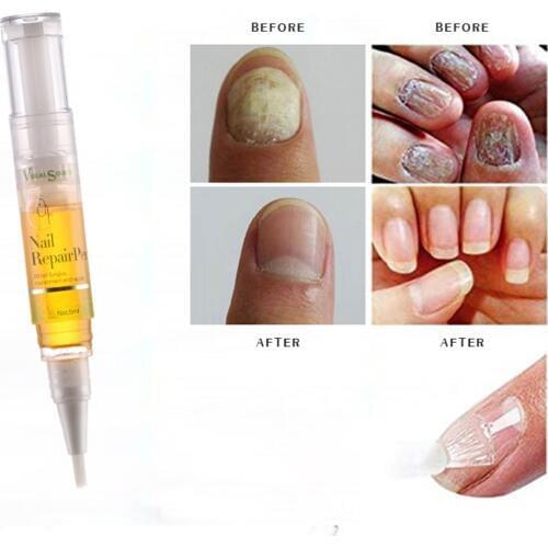 5ML Nail Treatment Liquid Pen Anti Fungal Nail Infection Toe Moisturize Nail Oil Repair Cuticle Remover Nail Care TSLM1