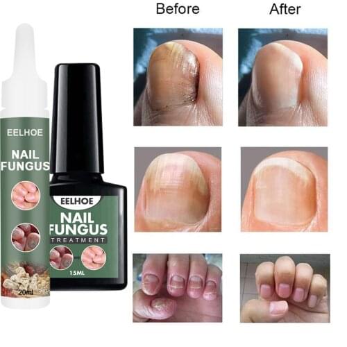 Nail Fungal Cure Nail Fungus Removal Liquid Nutritious Anti Nail Fungus Treatment Foot Repair Fungal Nail Repair Toenails