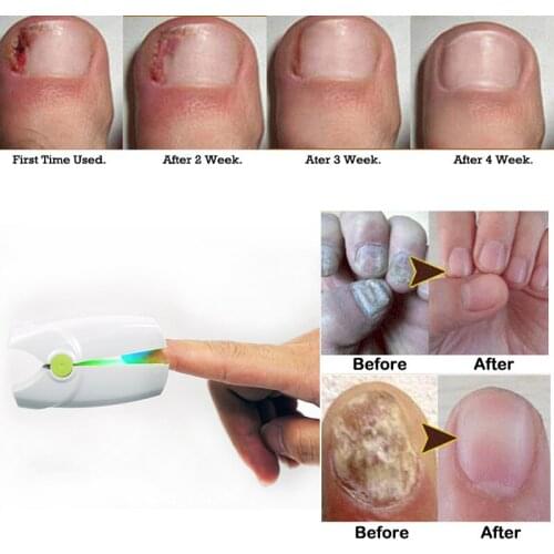 Fingernail toenail Fungus Clean laser therapy Nail Onychomycosis Treatment device Anti Fungal Infection Home Use Nail Repair