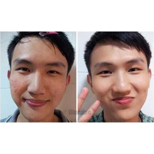 Pox Doctor Cream Fast Oil Control Anti-Acne Pimple Treatment Repairing Comedo Acne Clearing Heat Professional Acne Products 20g