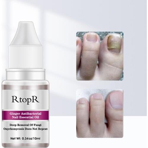 Fungal Nail Treatment Serum Onychomycosis Paronychia Anti-Fungal Nail Infection Herbal Toe Fungus Foot Repair Essence Care 10ml