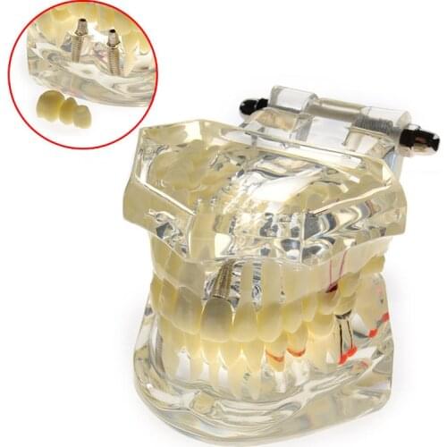 Dental Implant Disease Teeth Model With Restoration Bridge Tooth Dentist For Medical Science Dental Disease Teaching Study