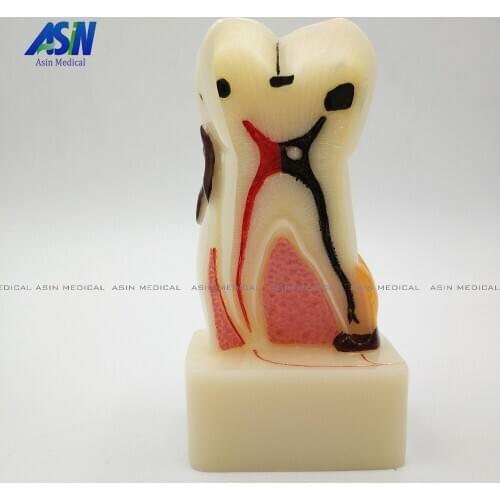 NEW Arrival high quality Dental implant Demonstration Bracket Simulation Teeth Model teeth removable
