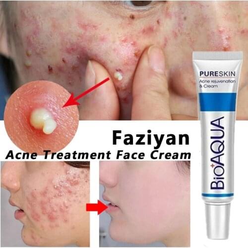 Anti Acne Cream Removal Of Acne Removal Of Blackheads Whitening Cream Scar Remove Reduce Acne Oil Control Shrink Pores