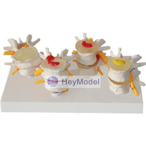 HeyModel Four-stage lumbar spine model Bone spurs Lumbar pathological model Intervertebral disc herniation