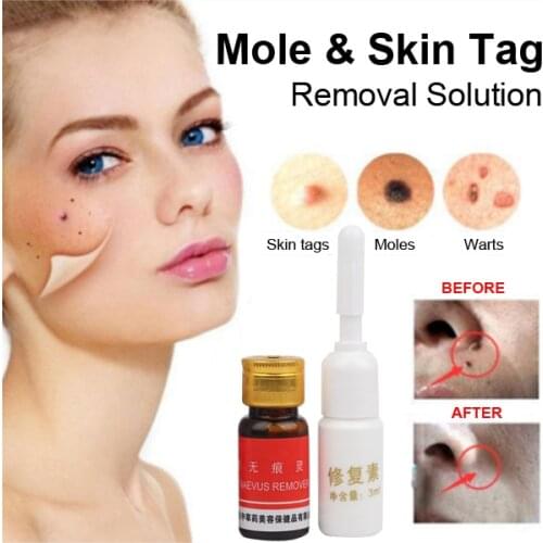 High Quality Mole Remover Set Skin Care Tags Warts Removal Repair Solution Kit
