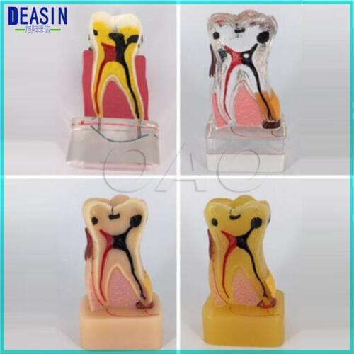 Teeth Disease Model 4:1 Dentist Dental Study Teach Tooth Model