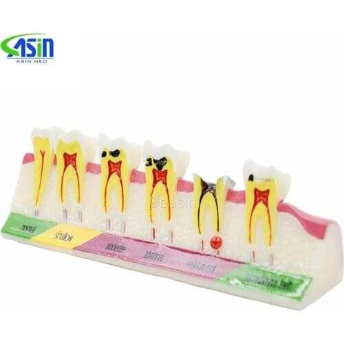 New Dental Caries Developing illusteation Tooth Model Demonstration Teach Patient