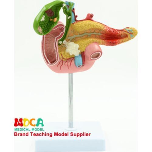 Pathological model of diseased pancreas duodenum and gallbladder