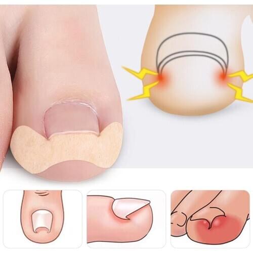 20pcs Professional Embedded Toe Nail Corrector Sticker Toenail Care Pedicure Thumb Curl Correction Sticker